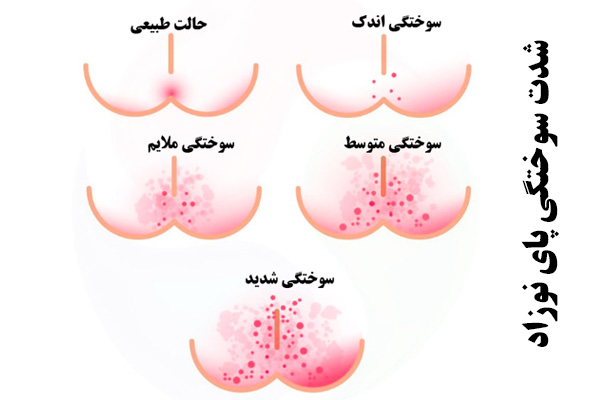 شدت سوختگی پای نوزاد 
