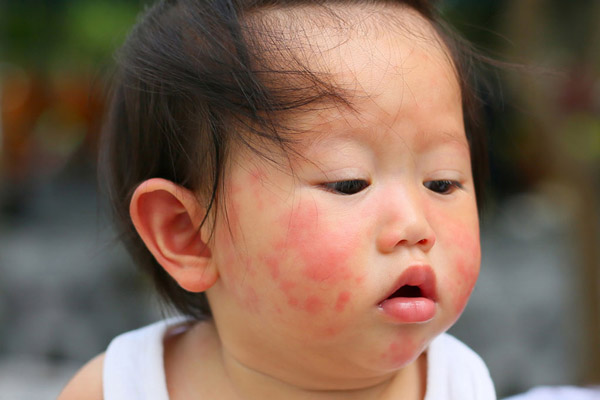 حساسیت‌های پوستی کودکان