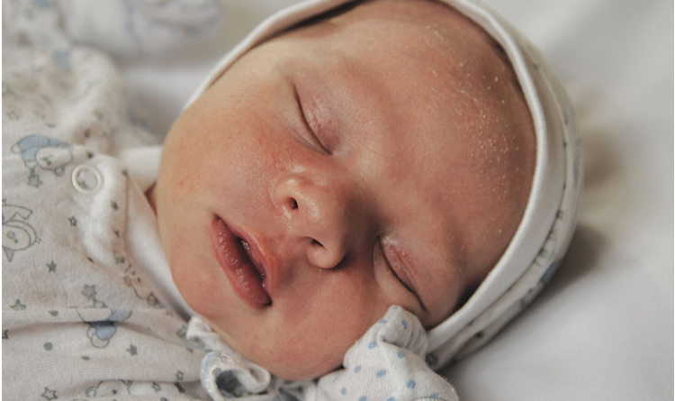 درماتیت سبوره یا کرادل کپ همان پوسته های سر و صورت نوزاد است که به کلاه گهواره هم مشهور است