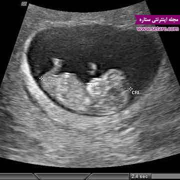 سونوگرافی جنین در هفته دهم بارداری