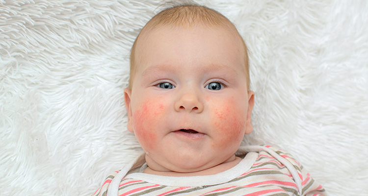 آلرژی به شیر در نوزادان