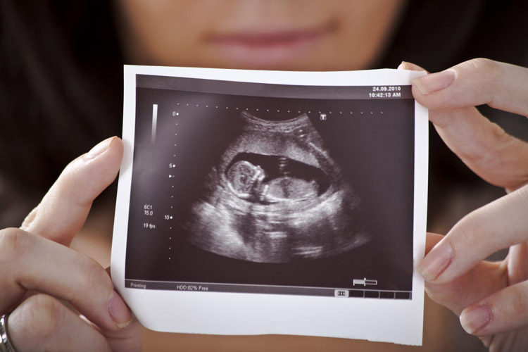 تشخیص بینی جنین در سونوگرافی NT