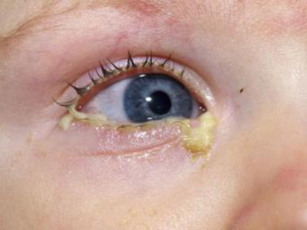 قی کردن چشم نوزاد: بیماری چشم صورتی (التهاب ملتحمه) در نوزادان و کودکان