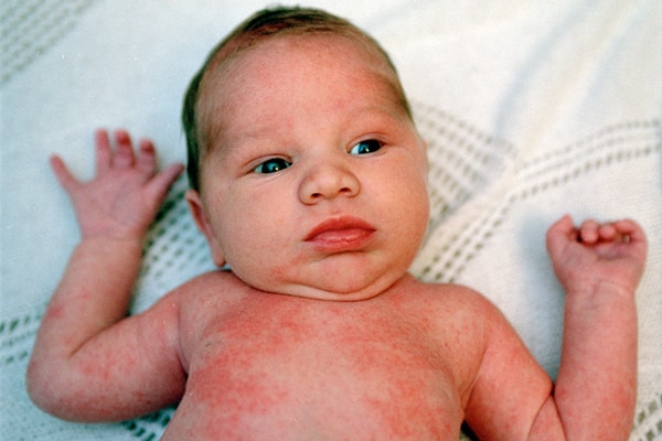 خشکی پوست نوزاد را چگونه درمان کنیم؟