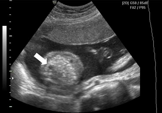 در سونوگرافی آنومالی متخصص یک بررسی بسیار دقیق از اندام جنین و رحم انجام می‌دهد