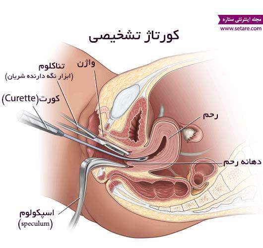 عوارض کورتاژ تشخیصی