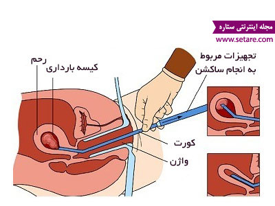 کورتاژ چگونه انجام میشود؟ کورتاژ چگونه انجام میشود؟
