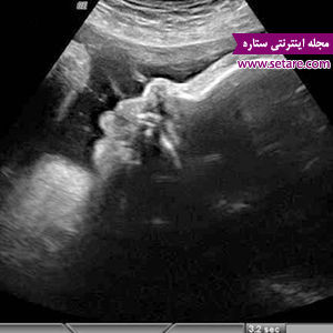بارداری هفته به هفته - هفته های بارداری - هفته سی و ششم بارداری