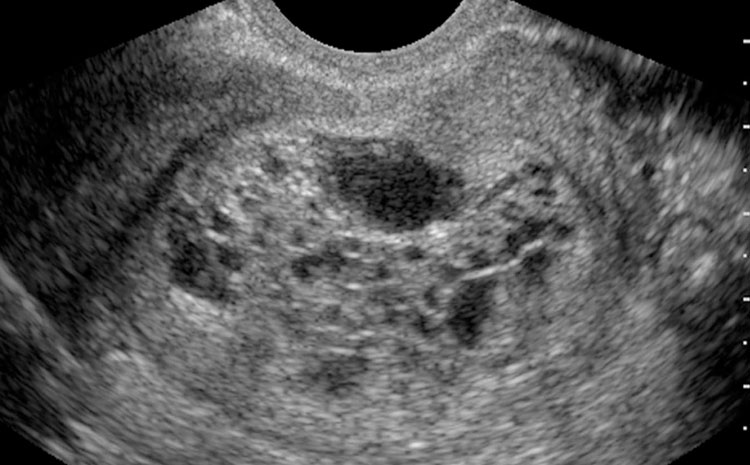 سونوگرافی بارداری مولار