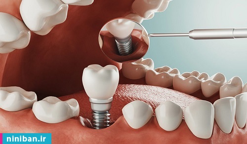 ایمپلنت دندان جلو فک پایین، جایگزینی مناسب برای دندان‌های از دست رفته