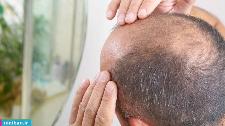 کاشت مو به روش سلولهای بنیادی، تحولی شگرف در درمان طاسیع