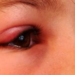 تورم چشم در نوزادان