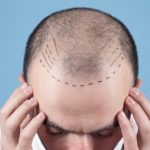کاشت مو به روش سلولهای بنیادی، تحولی شگرف در درمان طاسیع