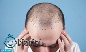 کاشت مو به روش سلولهای بنیادی، تحولی شگرف در درمان طاسیع