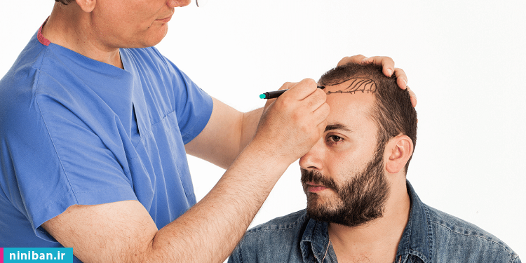کاشت مو به روش سلولهای بنیادی، تحولی شگرف در درمان طاسیع