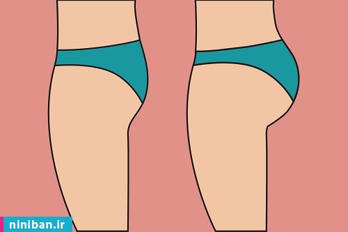 آنچه باید در مورد تزریق چربی به باسن بدانید! عوارض تزریق چربی به باسن