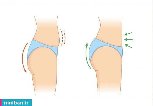 آنچه باید در مورد تزریق چربی به باسن بدانید! ماندگاری تزریق چربی به باسن