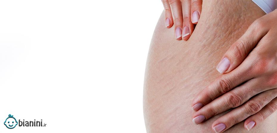 ترک‌های بارداری پوست درمان‌پذیر هستند؟