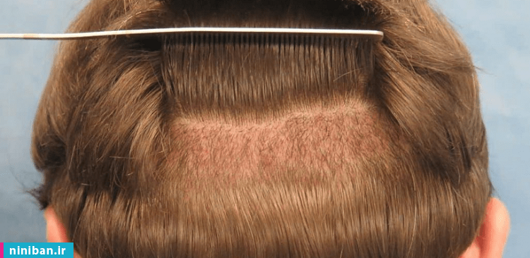 درصد موفقیت کاشت مو چقدر است؟