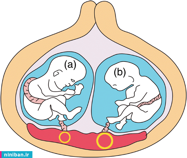 مراحل رشد جنین دوقلو، وزن نرمال