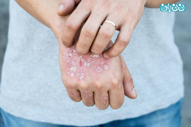 خطرات عفونت HPV در مردان درمان قطعی ویروس اچ پی وی در مردان