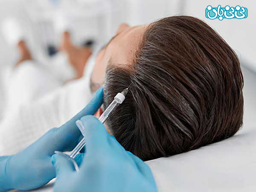 مزوتراپی مو درمان قطعی ریزش موی سر