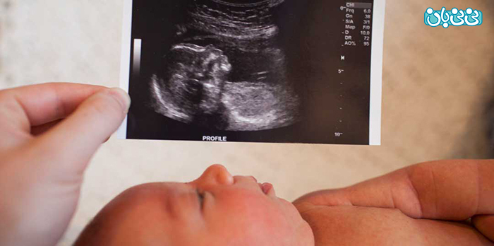 تشخیص بیماری‌های جنین، با سونوگرافی آنومالی اسکن