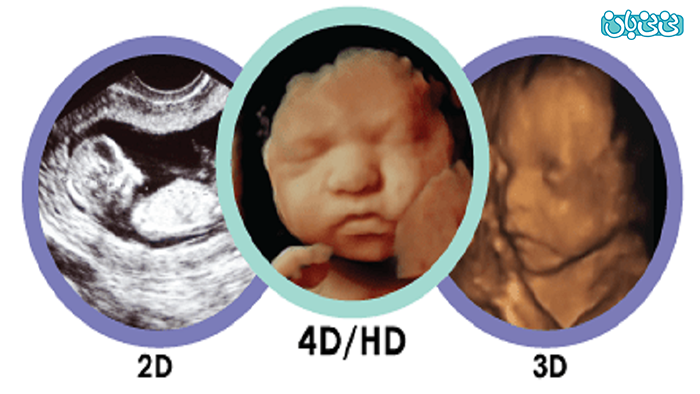 سونوگرافی سه بعدی جنین، چه کاربردهایی دارد؟