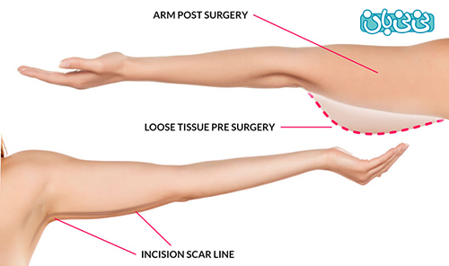 بهترین جراح بازو یا براکیوپلاستی در تهران کیست؟