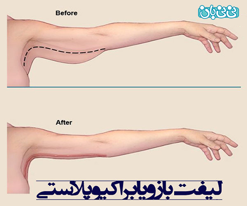 بهترین جراح بازو یا براکیوپلاستی در تهران کیست؟