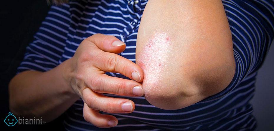 به چه علت روی پوستمان لکه‌های خشک ایجاد می‌شود؟