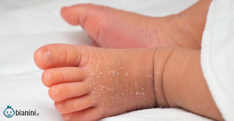 لایه‌برداری پوست در نوزادان