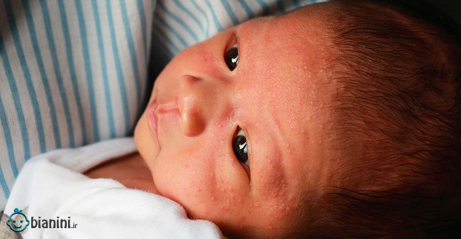 همه چیز درباره لکه‌های شیر ایجاد شده روی پوست نوزاد