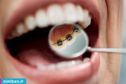 هزینه ارتودنسی از پشت دندان