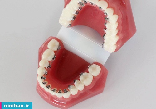 معایب ارتودنسی از پشت دندان