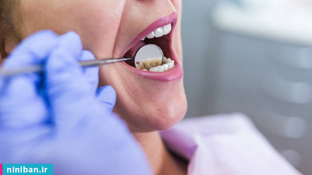 مراقبت های بعد از جراحی دندان عقل
