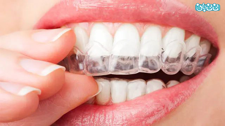 معرفی انواع بلیچینگ دندان، بررسی مزایا و معایب