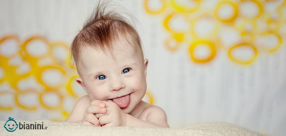 سندروم داون یک ناهنجاری ژنتیکی در جنین