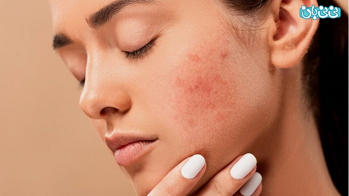 از بین بردن سریع جوش، یک شبه درمان میشه؟ از بین بردن سریع جوش، یک شبه درمان میشه؟