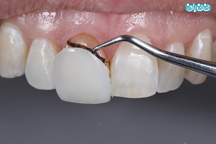 آیا کامپوزیت دندان قابل برداشتن است