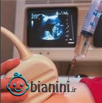 تشخیص اختلالات جنینی با تست آمینوسنتز بارداری