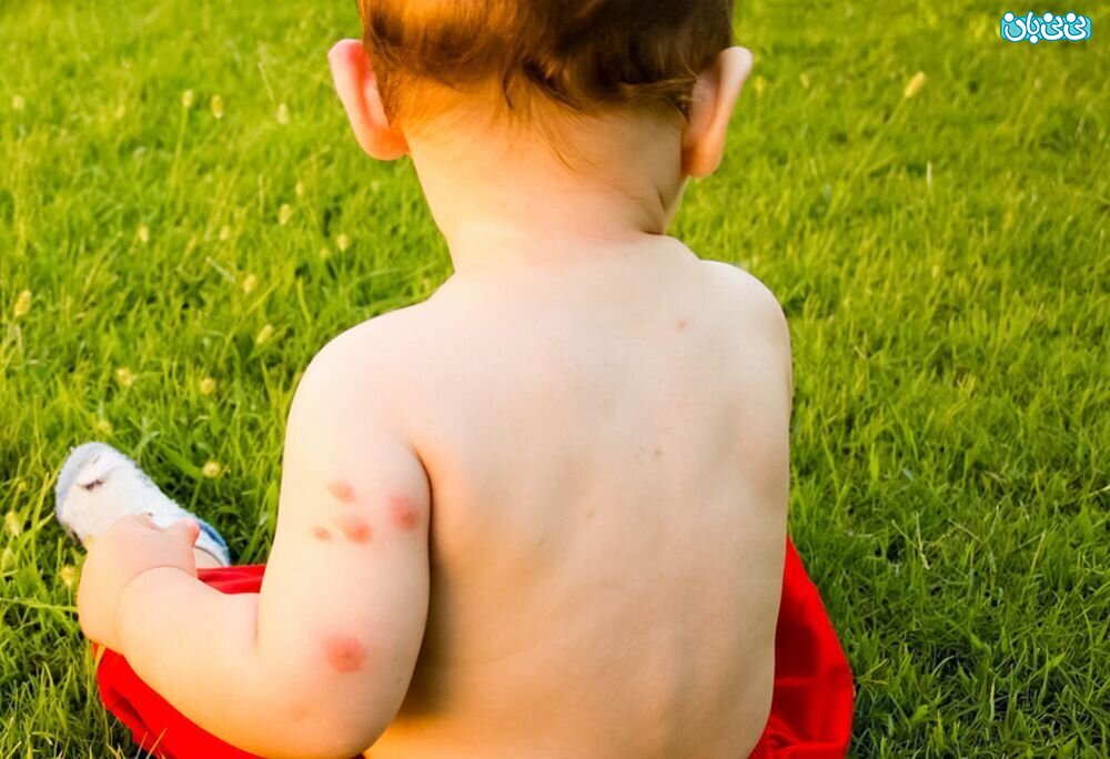 راهکارهارهای خانگی درمان گزیدگی حشرات در نوزادان که باید بدانید!