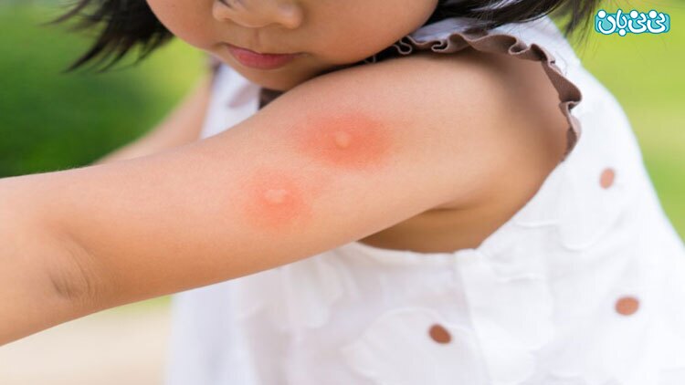 راهکارهارهای خانگی درمان گزیدگی حشرات در نوزادان که باید بدانید!