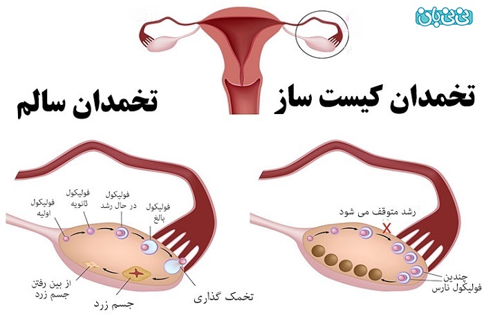 هر آنچه که لازم است درباره درمان کیست تخمدان زنان بدانید!