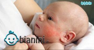 درمان حساسیت پوستی در کودکان، آلر