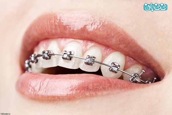 درمان به‌هم‌ریختگی دندان ها با ارتودنسی ، کامپوزیت و لمینت