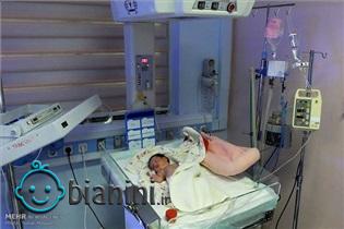 ارتباط تولد زودهنگام و ریسک ابتلا به آرتروز