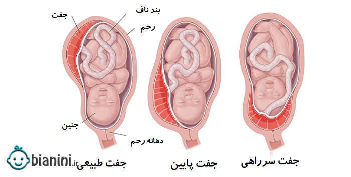 استراحت برای جفت پایین؛ آیا پایین بودن جفت با استراحت درمان می‌شود؟