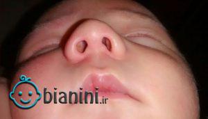انحراف بینی در نوزادان و کودکان، نشانه‌ها و راه‌های درمان