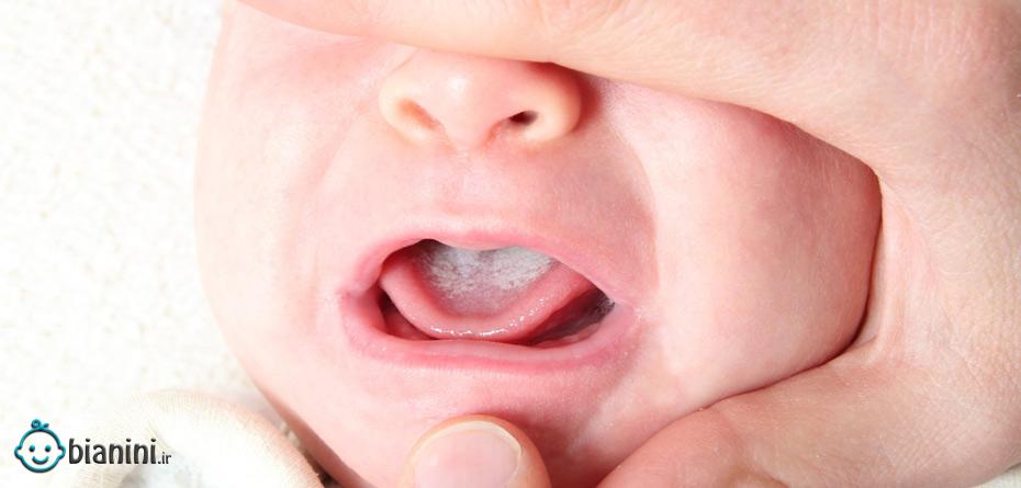 برفک دهان نوزاد و روش درمان آن